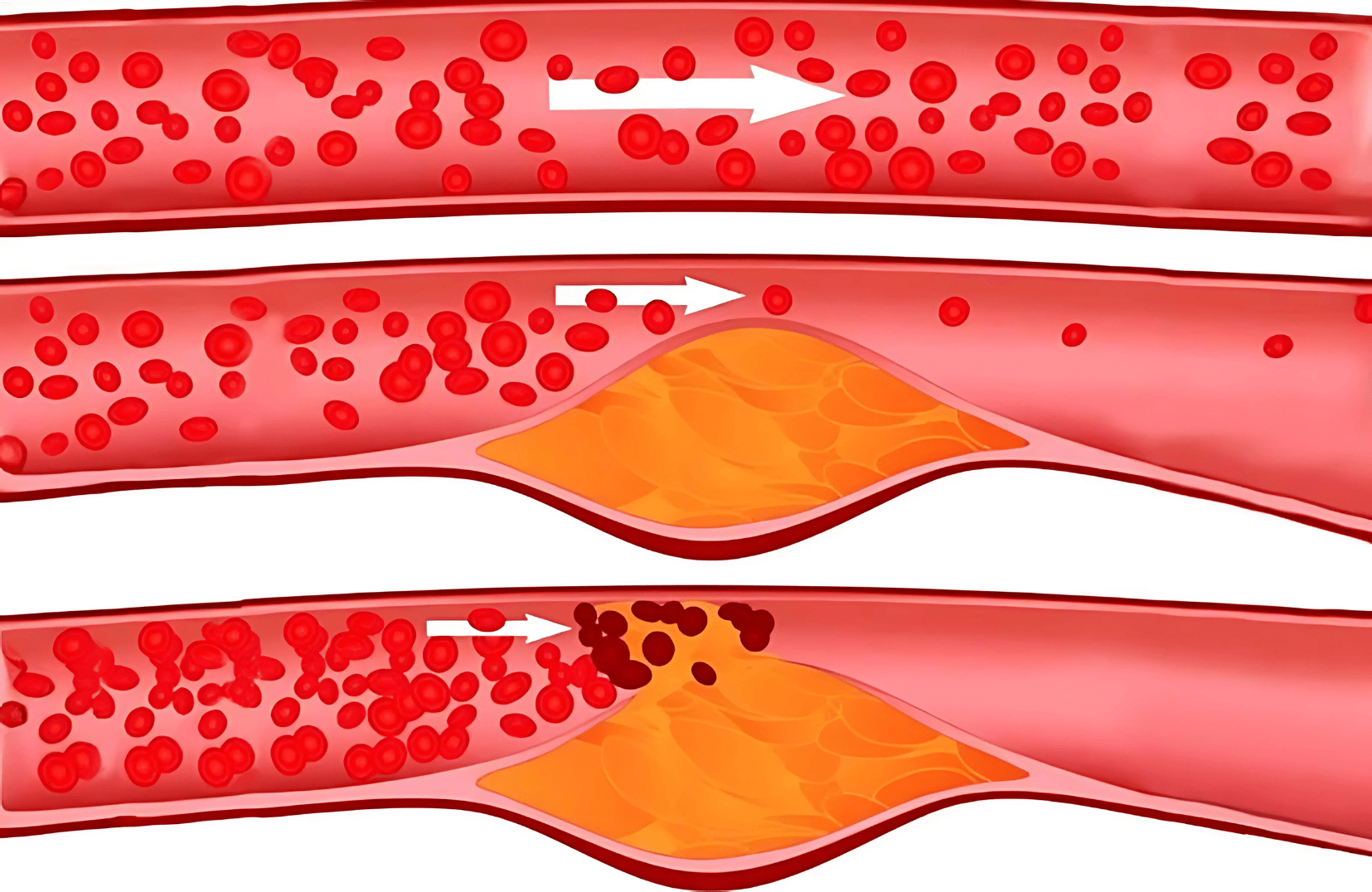 Photo: Illustration of the PowerVibe™ erection process – blood flow fills the penis rapidly and naturally.